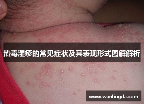 热毒湿疹的常见症状及其表现形式图解解析 热毒湿疹的常见症状及其表现形式图解解析